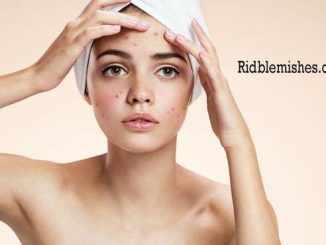 Reasons You Get Acne and How to Prevent Them